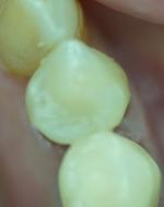 Picture of teeth that have had cavities repaired